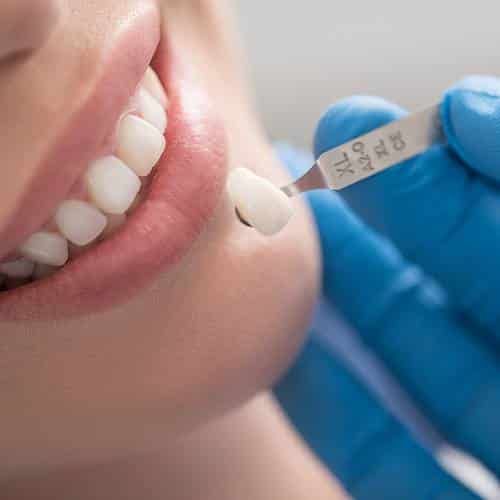 What Dental Issues Can Dental Veneers Fix?